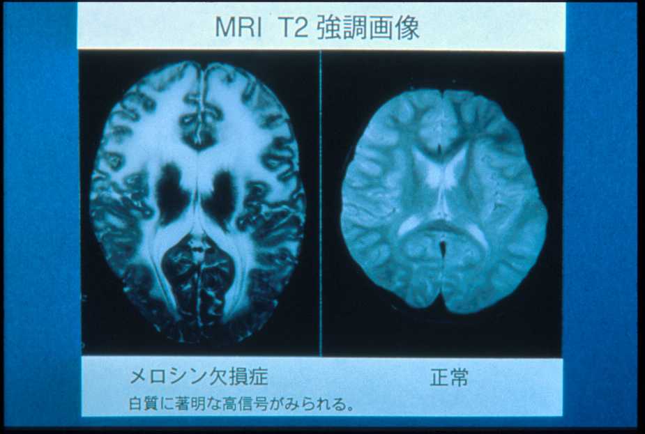 図２１:メロシン欠損型先天性筋ジストロフィーの脳MRI像