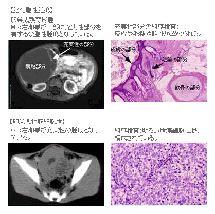 胚細胞性腫瘍