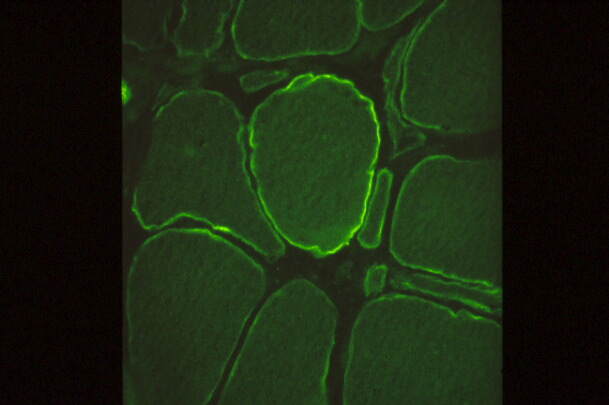 図１２: ベッカー型筋ジストロフィーの免疫組織化学的染色