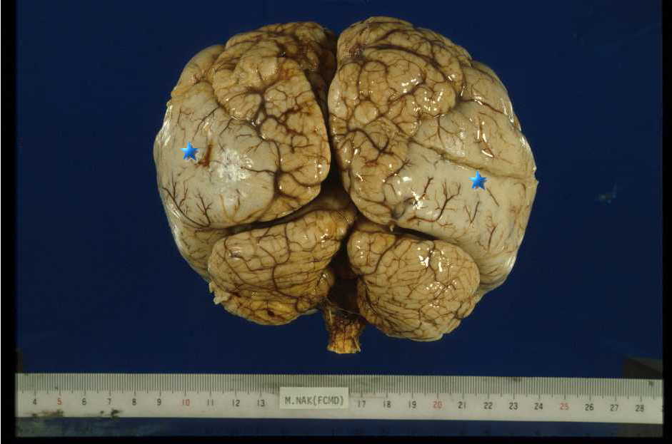 図１７:福山型先天性筋ジストロフィーの脳病理