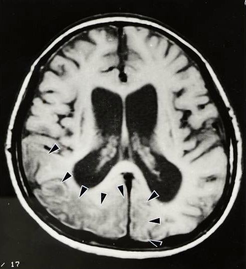 図３２:メラスの脳MRI(T1強調画像)