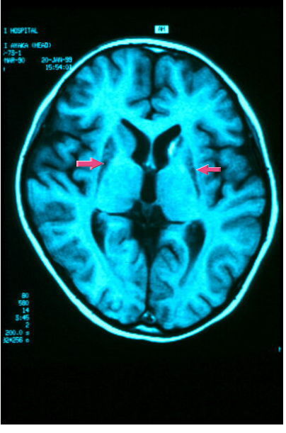図３４：リー脳症の脳ＣＴ像