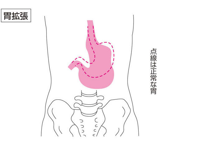 胃拡張の画像