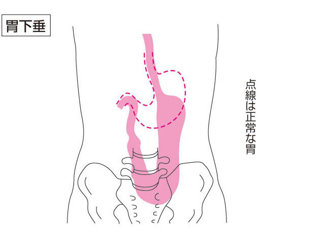 胃下垂の画像